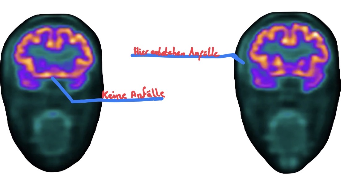 PET-Scan