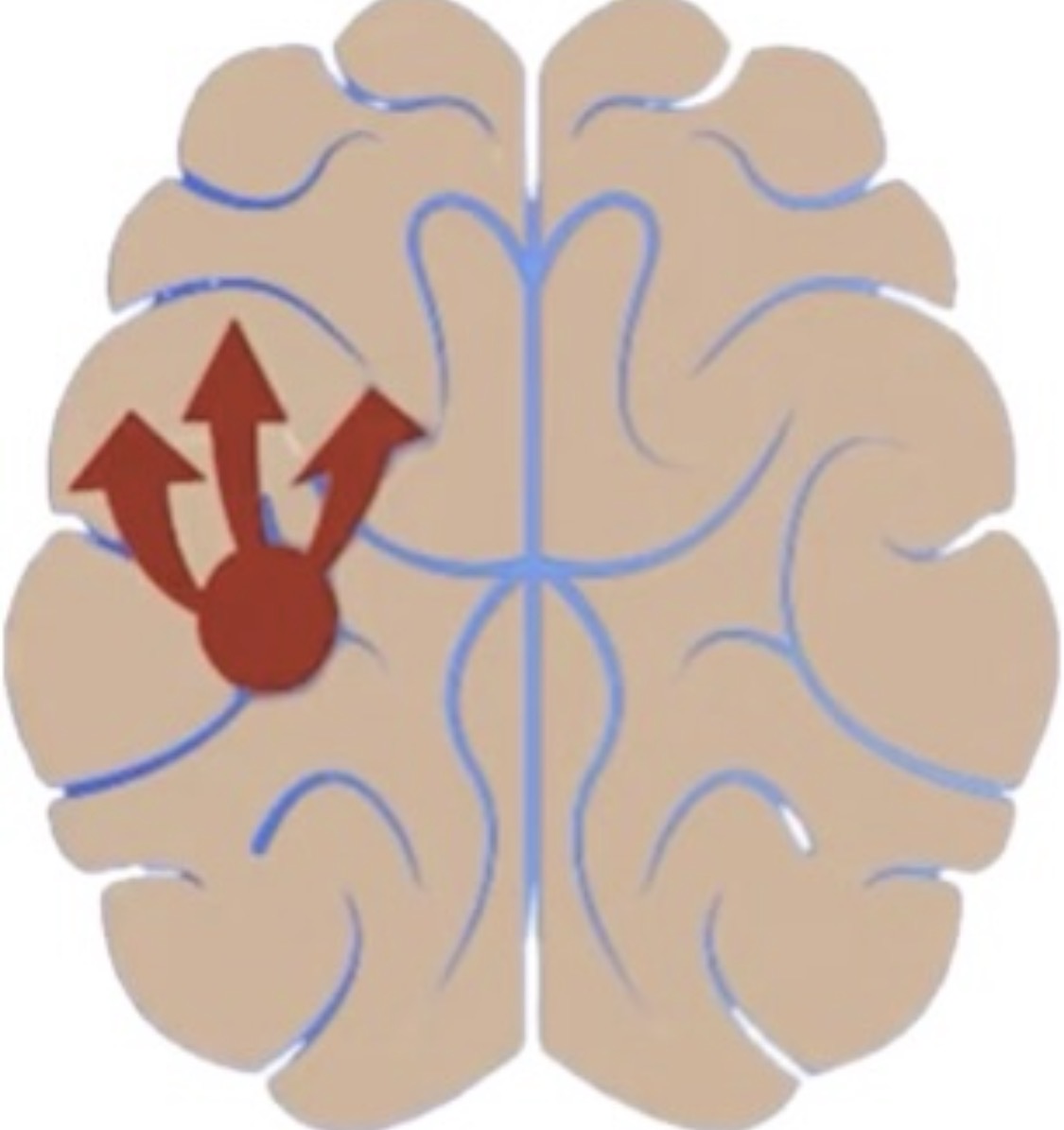 Fokale Epilepsie
